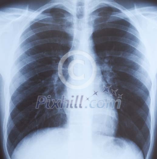 X-ray image of a ribcage