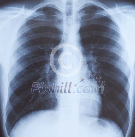 X-ray image of a ribcage X-ray image of a ribcage