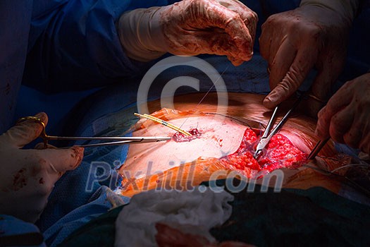 Surgery in a modern hospital being performed by a team of professionals (shallow DOF, color toned image) Surgery in a modern hospital being performed by a team of professionals (shallow DOF, color toned image)