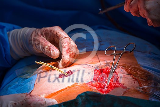 Surgery in a modern hospital being performed by a team of professionals (shallow DOF, color toned image)