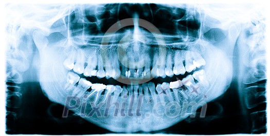 Teeth and jaw  dental  x-ray image