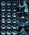 Magnetic resonance tomography (MRT) images of knee