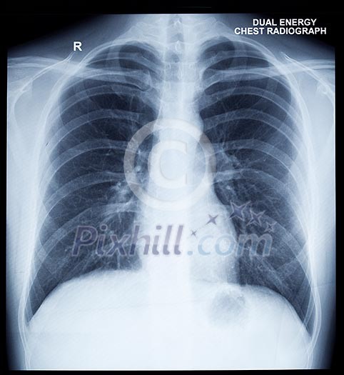 X-Ray Image Of Human Healthy Chest X-Ray Image Of Human Healthy Chest