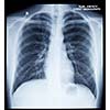 X-Ray Image Of Human Healthy Chest