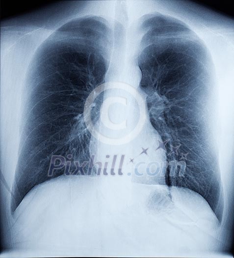 X-Ray Image Of Human Healthy Chest X-Ray Image Of Human Healthy Chest