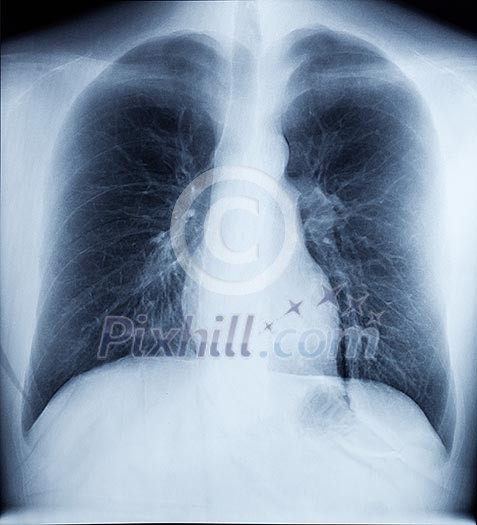 X-Ray Image Of Human Healthy Chest