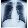 X-Ray Image Of Human Healthy Chest