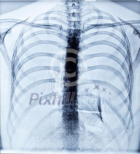 X-Ray Image Of Human Healthy Chest X-Ray Image Of Human Healthy Chest