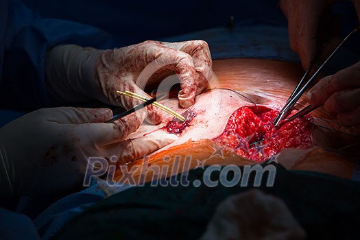 Surgery in a modern hospital being performed by a team of professionals (shallow DOF, color toned image)
