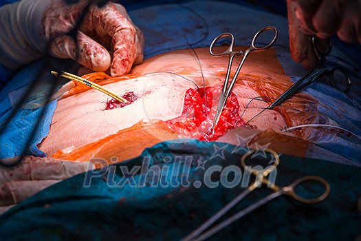 Surgery in a modern hospital being performed by a team of professionals (shallow DOF, color toned image) Surgery in a modern hospital being performed by a team of professionals (shallow DOF, color toned image)