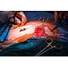 Surgery in a modern hospital being performed by a team of professionals (shallow DOF, color toned image)