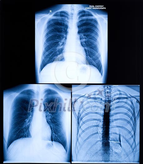 X-Ray Image Of Human Healthy Chest