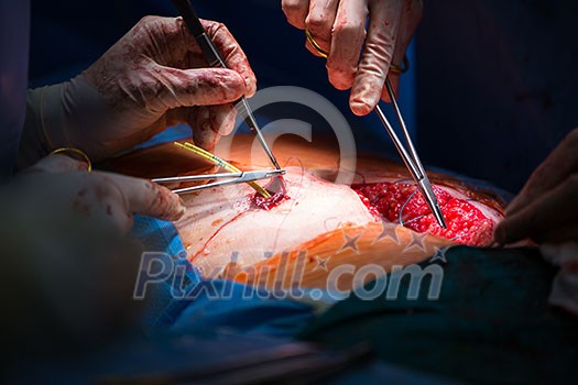 Surgery in a modern hospital being performed by a team of professionals (shallow DOF, color toned image) Surgery in a modern hospital being performed by a team of professionals (shallow DOF, color toned image)
