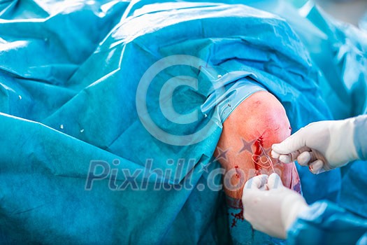 Knee surgery, Orthopedic Operation - two surgeons performing a knee surgery on a patient (shallow DOF; color toned image) Knee surgery, Orthopedic Operation - two surgeons performing a knee surgery on a patient (shallow DOF; color toned image)