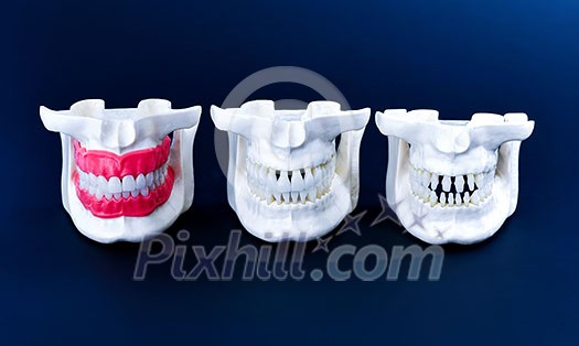 Human jaws with teeth and gums anatomy models medical illustration isolated on blue background. Healthy teeth, dental care and orthodontic concept