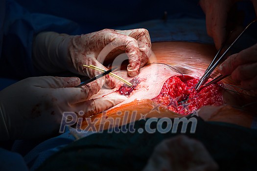 Surgery in a modern hospital being performed by a team of professionals (shallow DOF, color toned image) Surgery in a modern hospital being performed by a team of professionals (shallow DOF, color toned image)