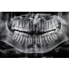 Orthopantomography, OPG X-ray DR digital wisdom teeth. panoramic film x ray dental