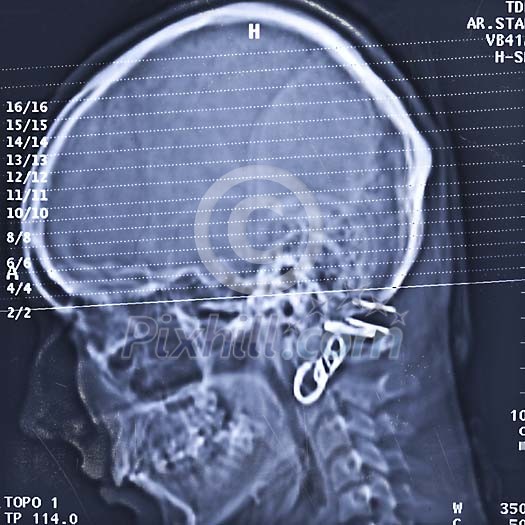 X-ray image of a head X-ray image of a head