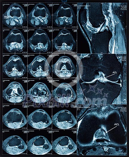Magnetic resonance tomography (MRT) images of knee Magnetic resonance tomography (MRT) images of knee