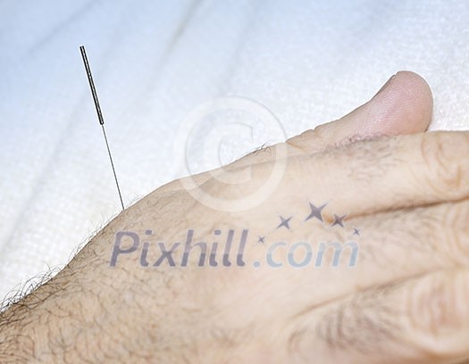 Closeup of acupuncture needle inserted in male hand Closeup of acupuncture needle inserted in male hand