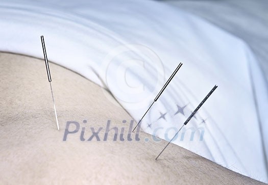Closeup of acupuncture needles inserted in man's shoulder Closeup of acupuncture needles inserted in man's shoulder