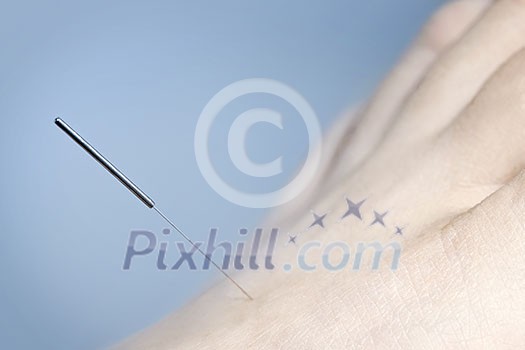 Closeup of acupuncture needle inserted in foot Closeup of acupuncture needle inserted in foot