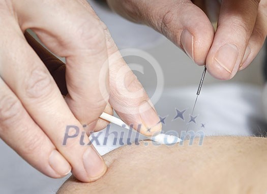 Closeup of acupuncture needle being removed from skin Closeup of acupuncture needle being removed from skin