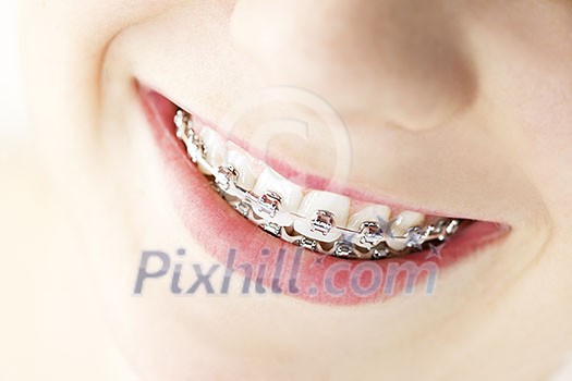Closeup on braces and white teeth of smiling girl Closeup on braces and white teeth of smiling girl