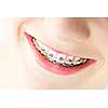 Closeup on braces and white teeth of smiling girl