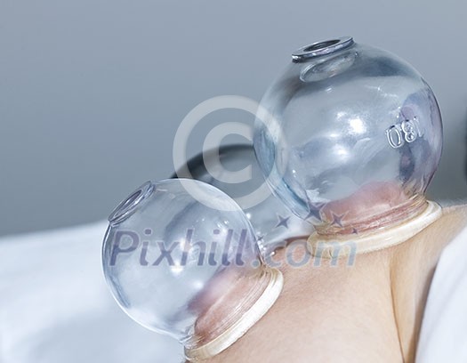 Applying cupping therapy in traditional chinese medicine on man's shoulder Applying cupping therapy in traditional chinese medicine on man's shoulder