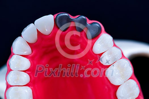 Teeth implant and crown installation process isolated on a blue background. Medically accurate 3D illustration Teeth implant and crown installation process isolated on a blue background. Medically accurate 3D illustration