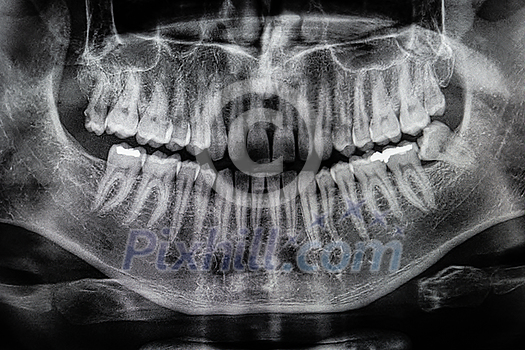 Orthopantomography, OPG X-ray DR digital wisdom teeth. panoramic film x ray dental Orthopantomography, OPG X-ray DR digital wisdom teeth. panoramic film x ray dental