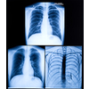 X-Ray Image Of Human Healthy Chest